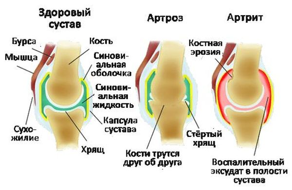 Изображение - Чем отличается артрит от артроза голеностопного сустава YxwtJkTf5eZ1