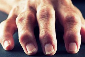 Лечение полиартрита пальцев рук народными средствами