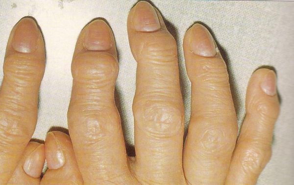 Вторая стадия характеризуется появлением на пальцах узелков