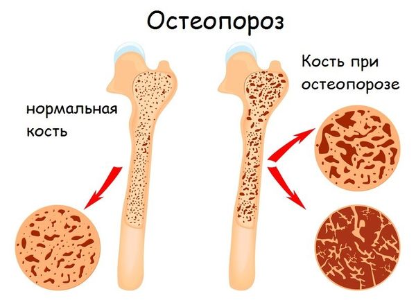 Остеопороз опасен повышенной травматизацией костной ткани